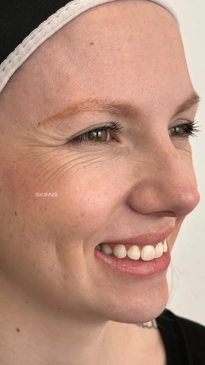 Antes — Blefaropeel