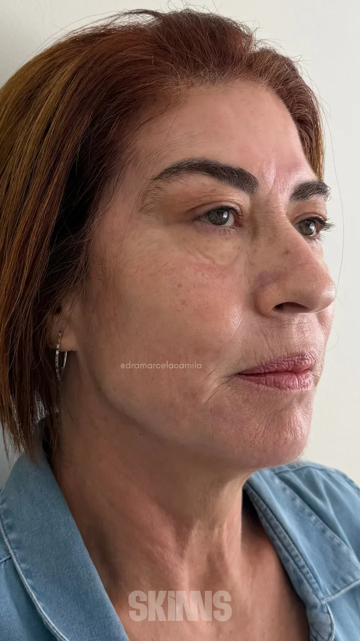Depois — Skims Rejuvenescimento