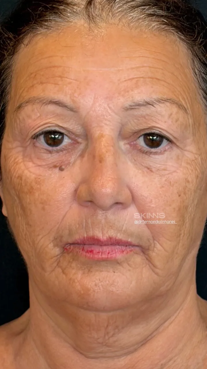 Antes — Skims Rejuvenescimento