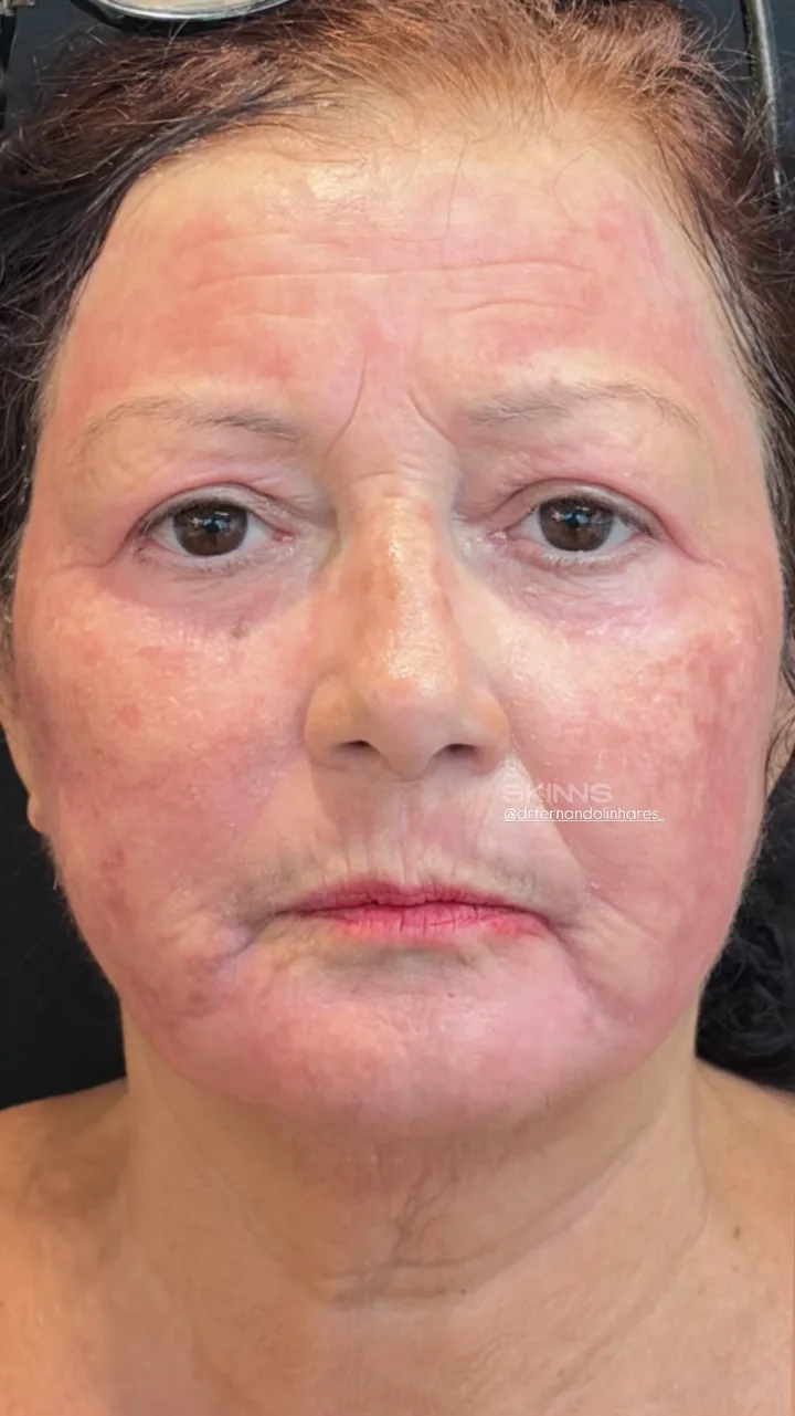 Depois — Skims Rejuvenescimento