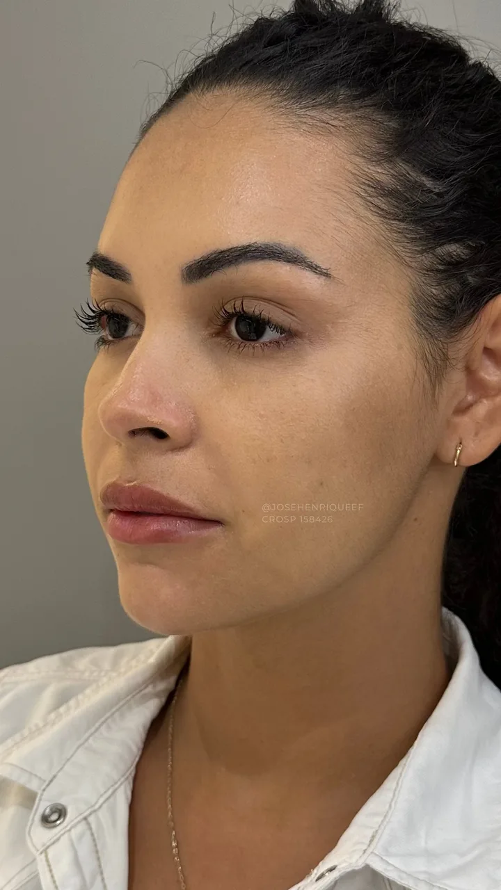 Depois — Preenchimentos Faciais