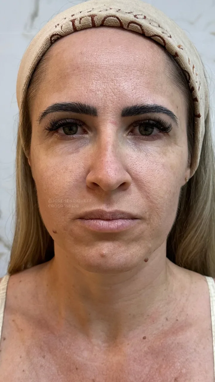 Antes — Preenchimentos Faciais