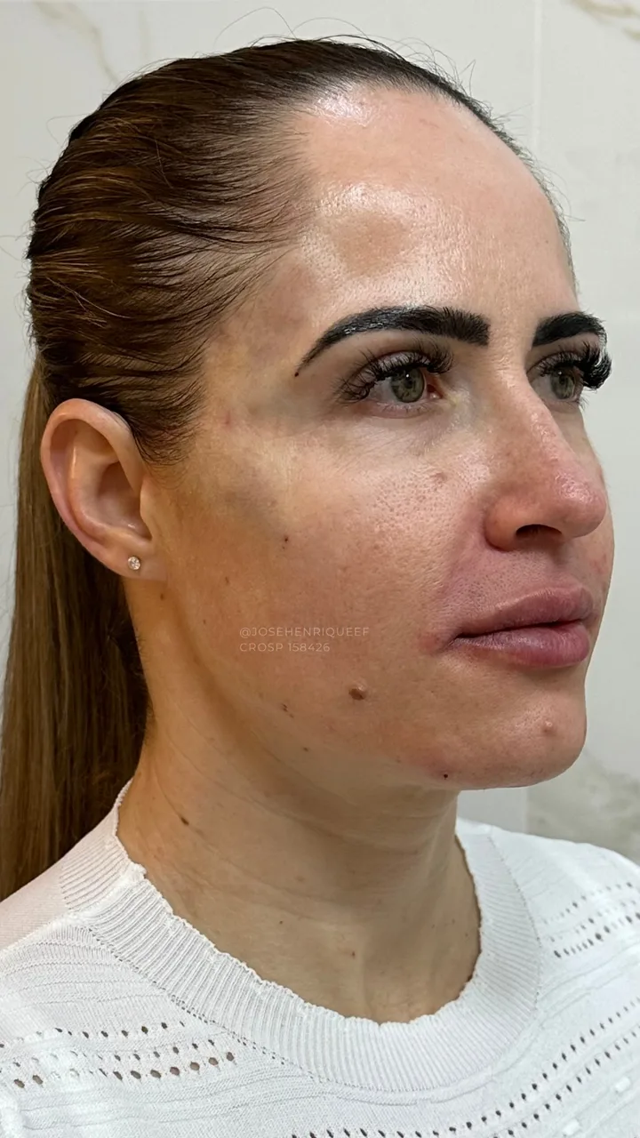 Depois — Preenchimentos Faciais