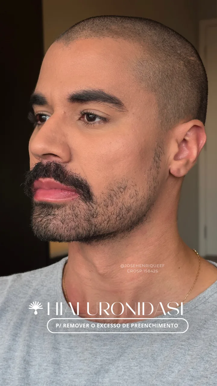 Depois — Protocolo Reverse