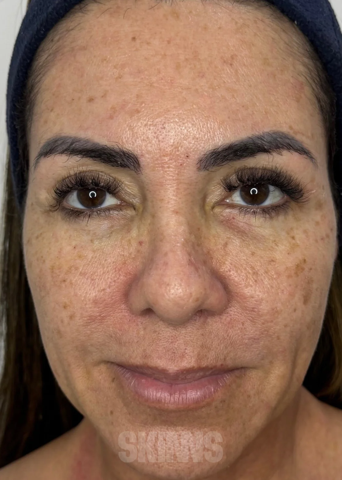 Resultado do Método SKIMS — foto 21