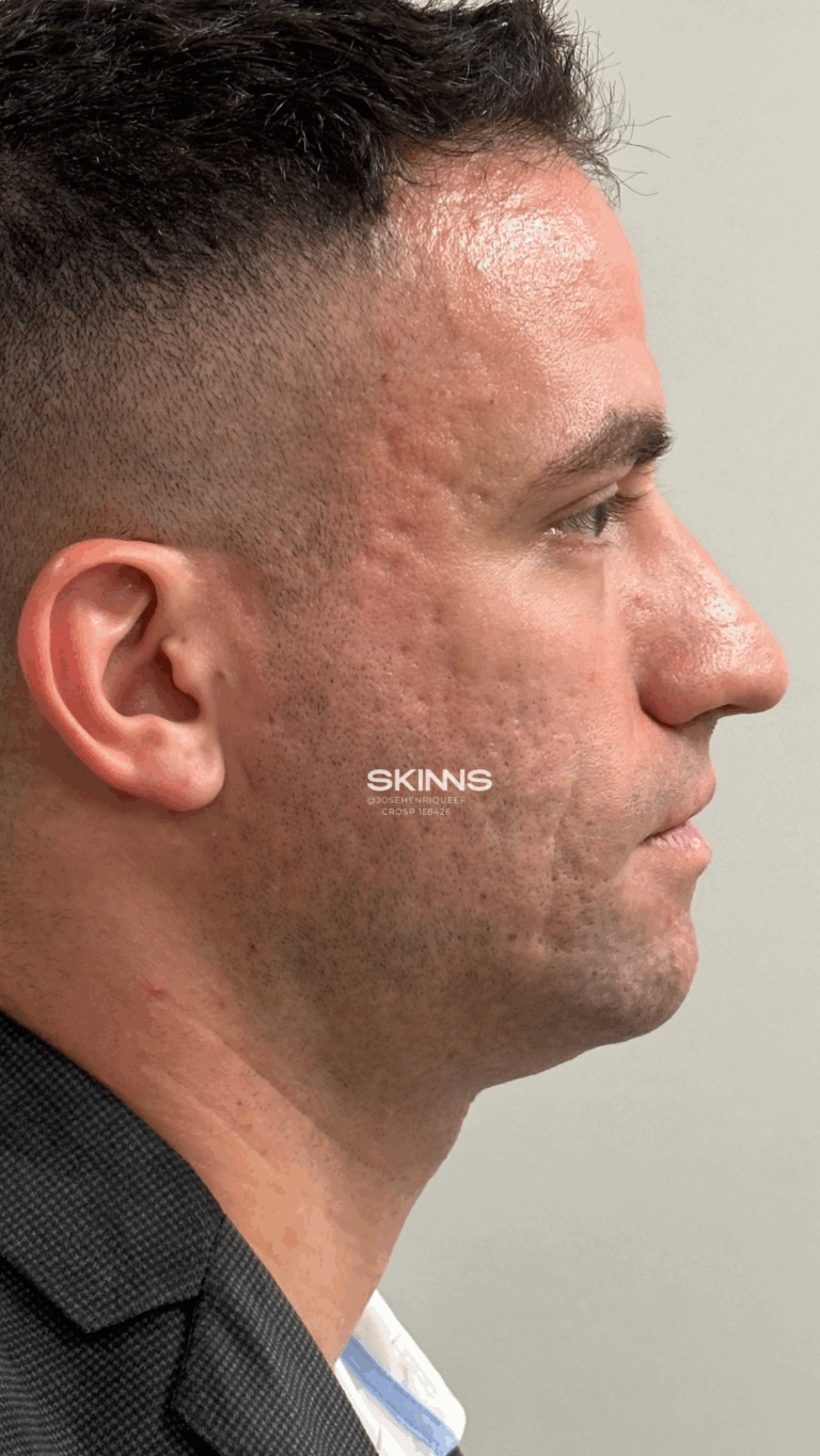 Antes — Peeling, paciente Ciro Gonçalves